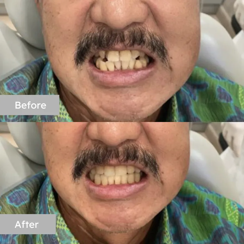 Facelift 2