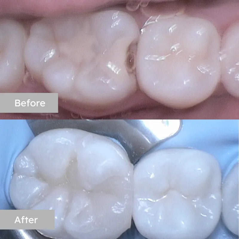 Fissure Sealant