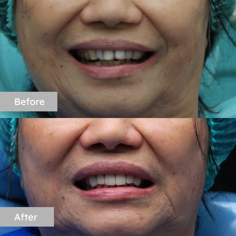 facelift 1